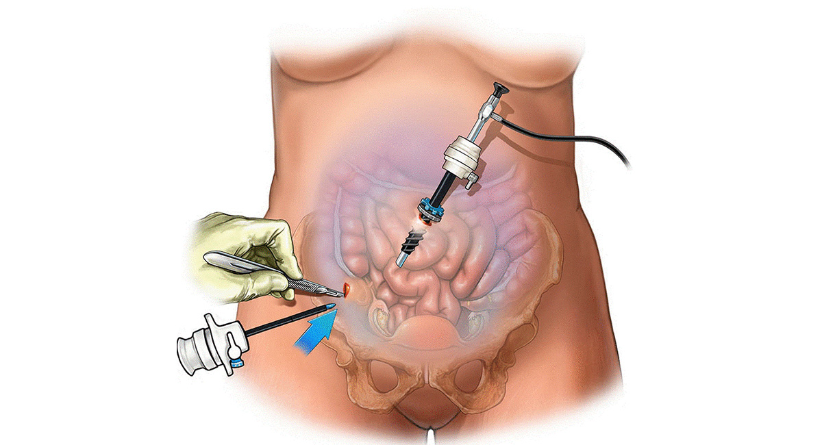 Laparoscopy