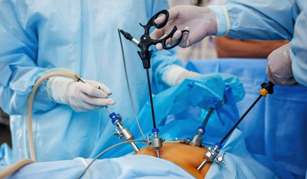Laparoscopy