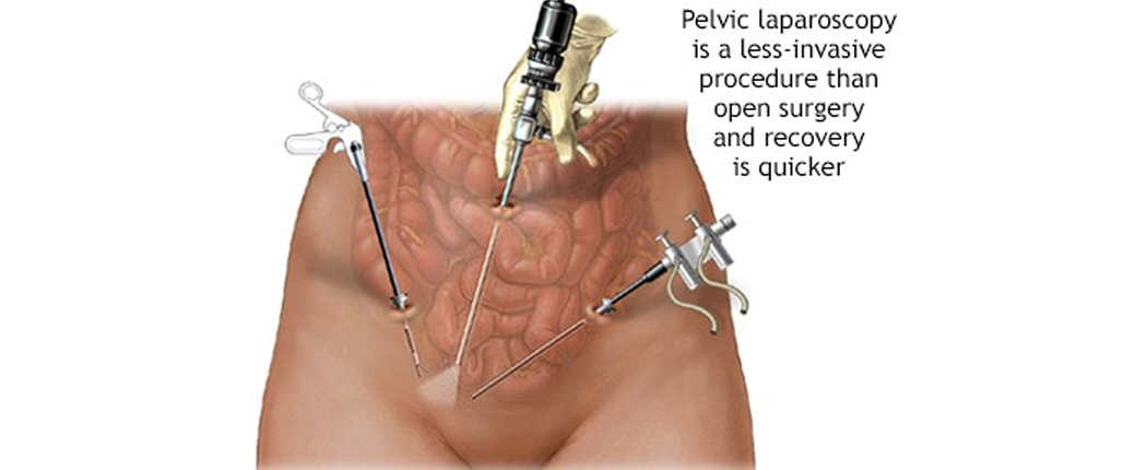 Laparoscopy