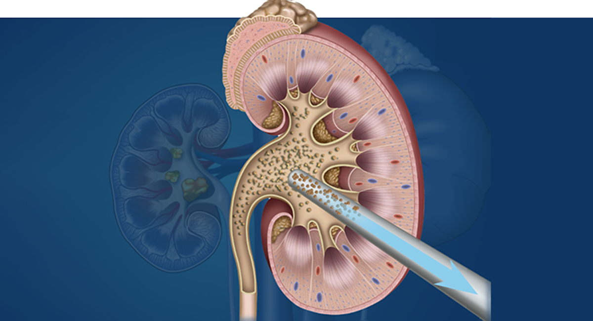 PCNL Treatment