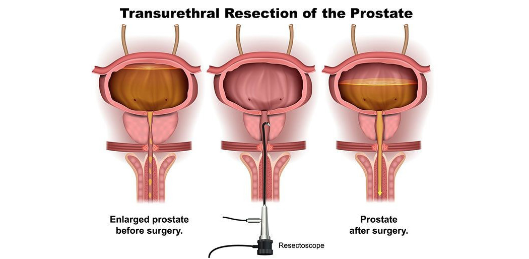Prostate BPH