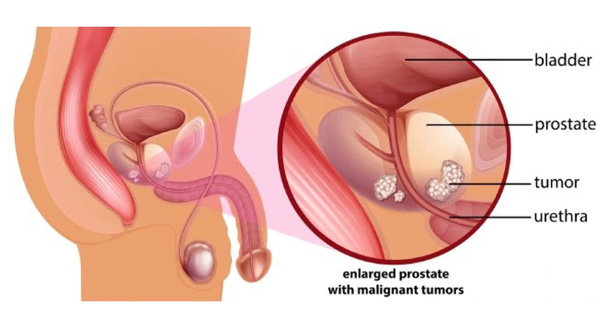 Prostate Cancer