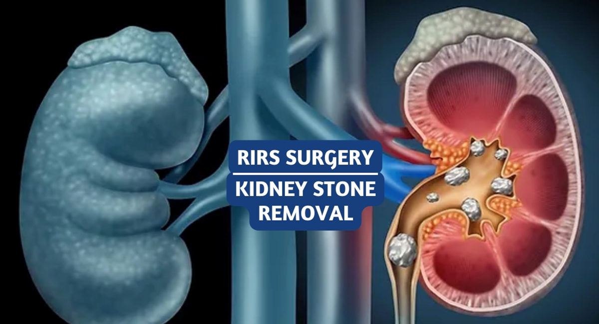 RIRS Surgery