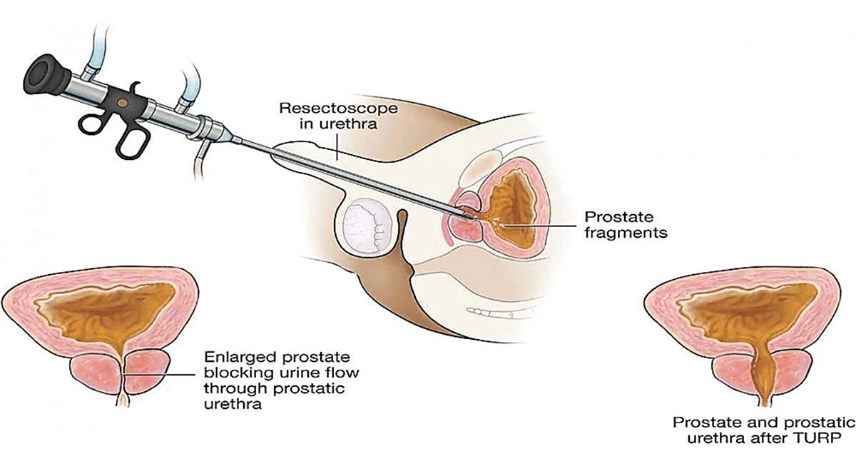 TURP Treatment