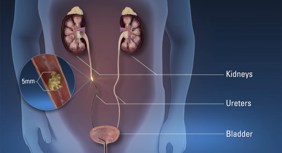 Ureteroscopic Lithotripsy (URSL)