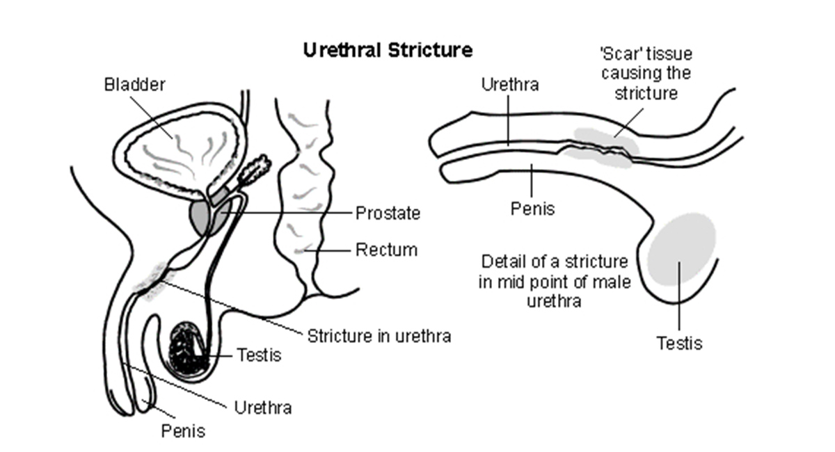 Urethral Stricture